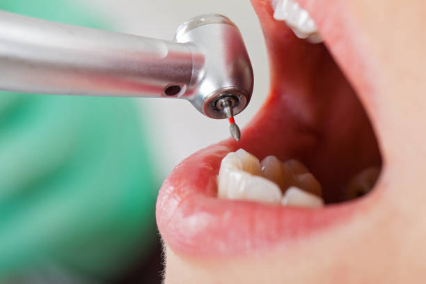 Best Emergency Treatment for Dental Infections or Abscesses in Glendale, WI